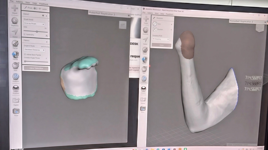 3D-printed prosthetics